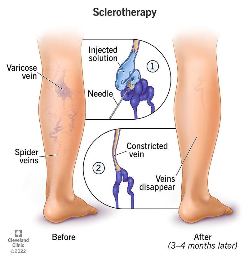 Injection Sclerotherapy
